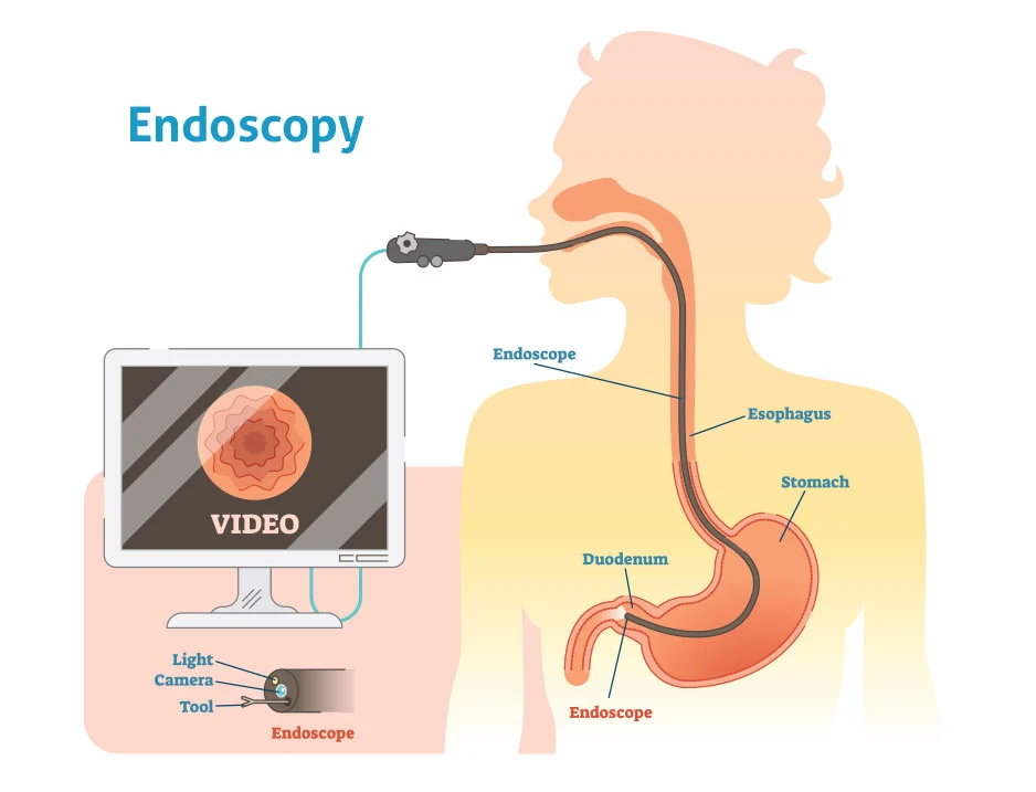 endoscopy medical diagram.