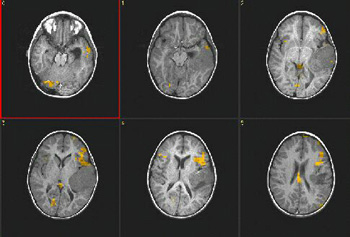 language_tumor.jpg language_tumor.jpg