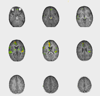 propofol1.jpg propofol1.jpg
