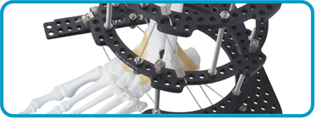 Ilizarovmethod.png Ilizarovmethod.png