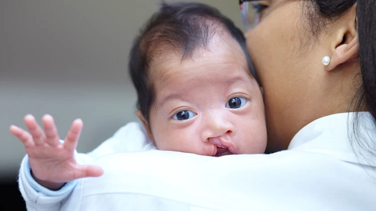 baby with cleft lip.