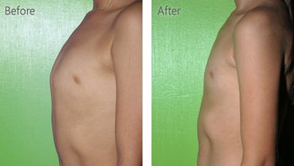 Pectus-Carinatum.jpg Pectus-Carinatum.jpg