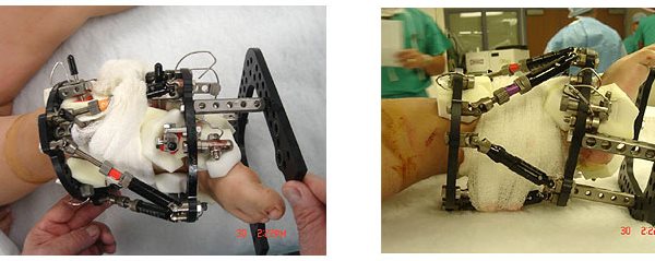 limbDeformitiesCongenital2.jpg limbDeformitiesCongenital2.jpg