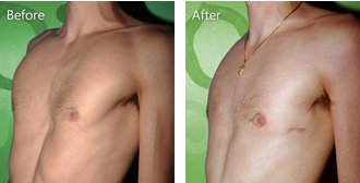 Pectus-Excavatum.jpg Pectus-Excavatum.jpg