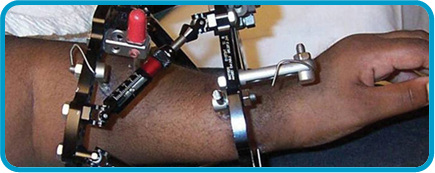 fixiator.png fixiator.png