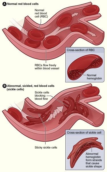 scd_cell-comparison.jpg scd_cell-comparison.jpg