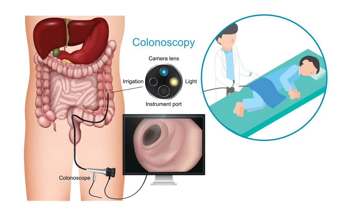 colonoscopy diagram.