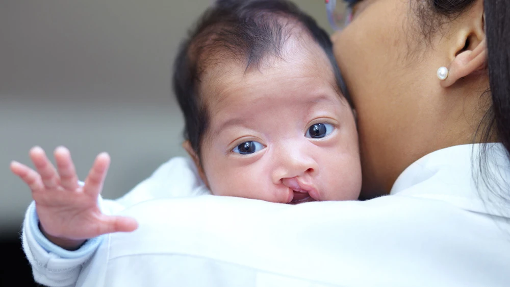 baby with cleft lip.
